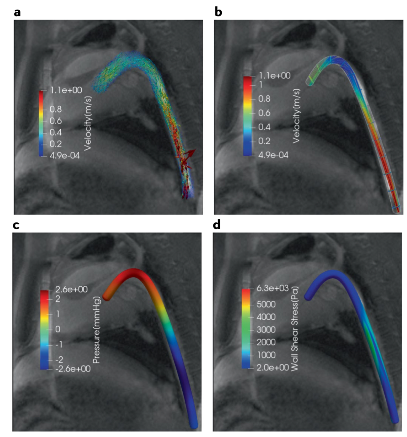 De-noising and reconstructing clinical magnetic resonance imaging (MRI) data of blood velocit, (a) Snapshot of in-vivo 4D-flow MRI measurements. (b–d) PINN reconstruction of the velocity field (b), pressure (c), arterial wall surface geometry and wall shear stresses (d)
